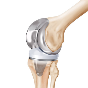 contact us - knee replacement