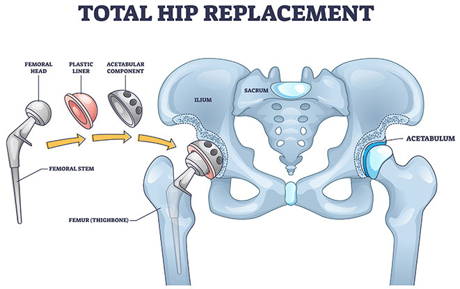 Hip Replacement Surgery