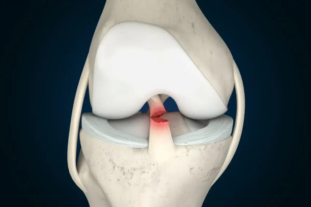 Knee Ligament Reconstruction