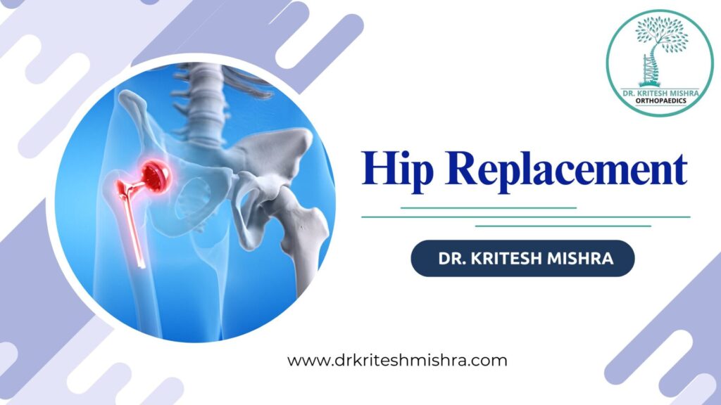 Hip Replacement Surgery