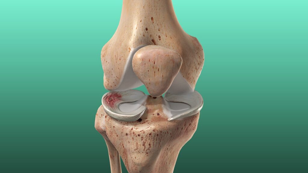 Meniscus Tear Treatment