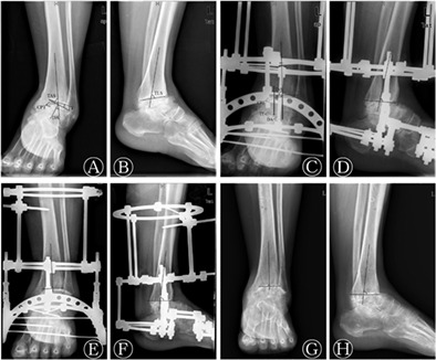 Deformity Correction