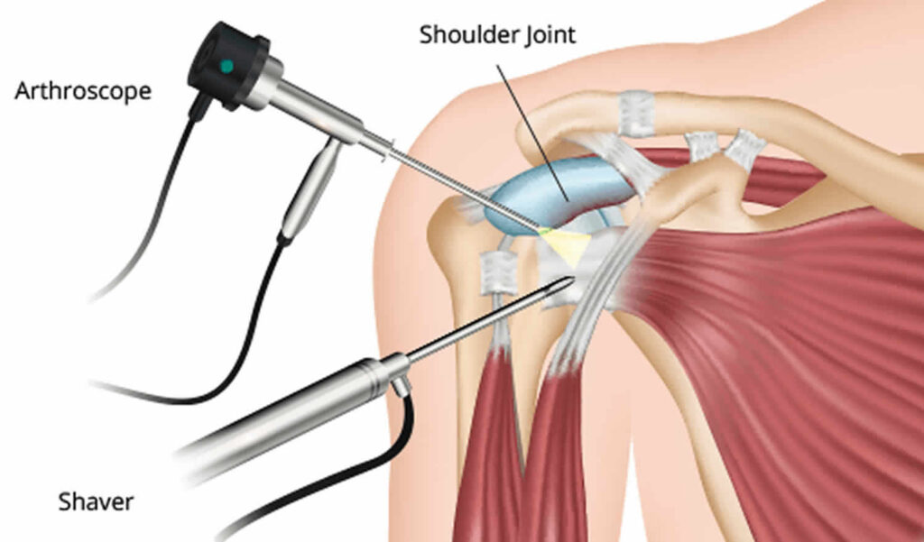 shoulder arthroscopy