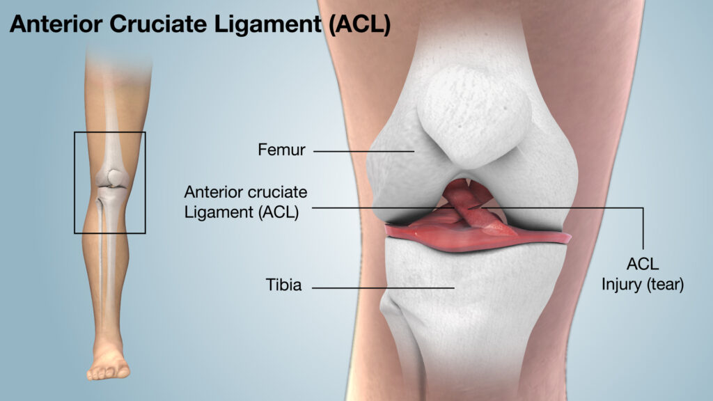 ACL-Injury