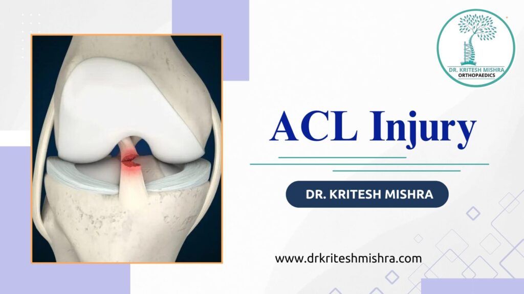 ACL Injury