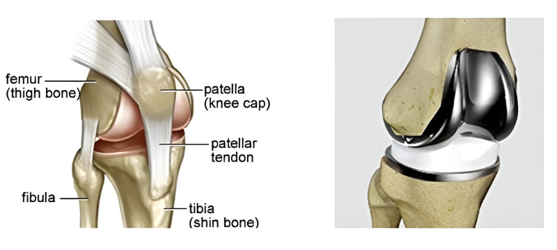 Total Knee replacement