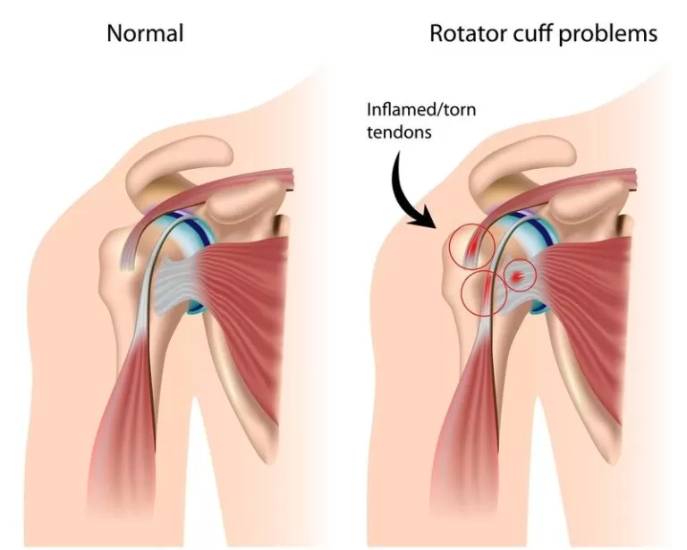 Rotator Cuff Tears