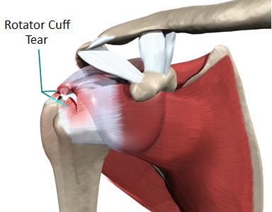 Rotator Cuff Tears