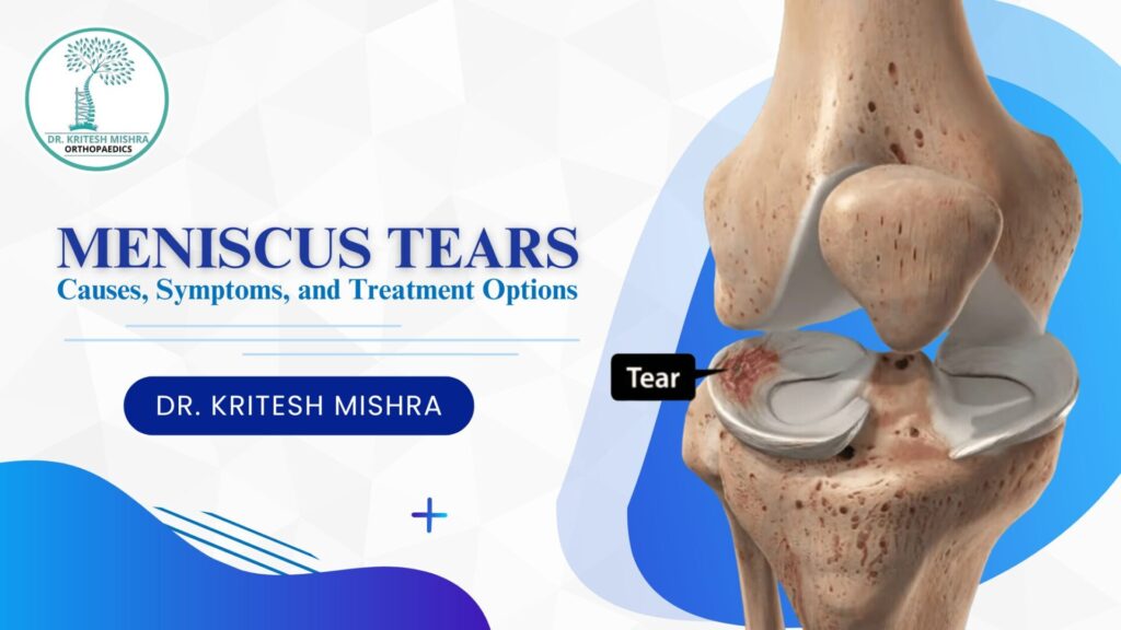 Meniscus Tears