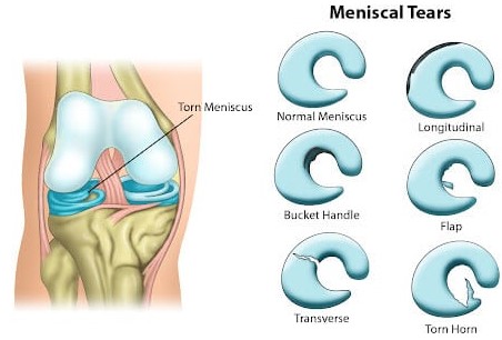 Meniscus Tears