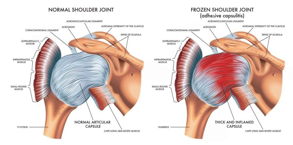 Frozen Shoulder