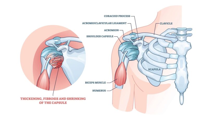 Frozen Shoulder