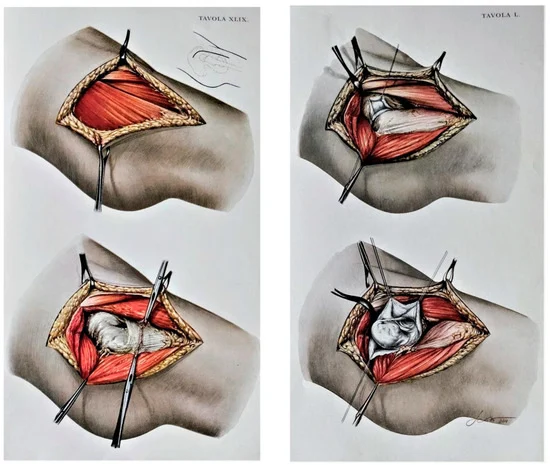 DAA Hip Replacement